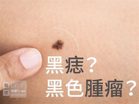 睪丸 黑痣|不大驚小怪！如何辨別「黑痣」與「黑色腫瘤」？ 